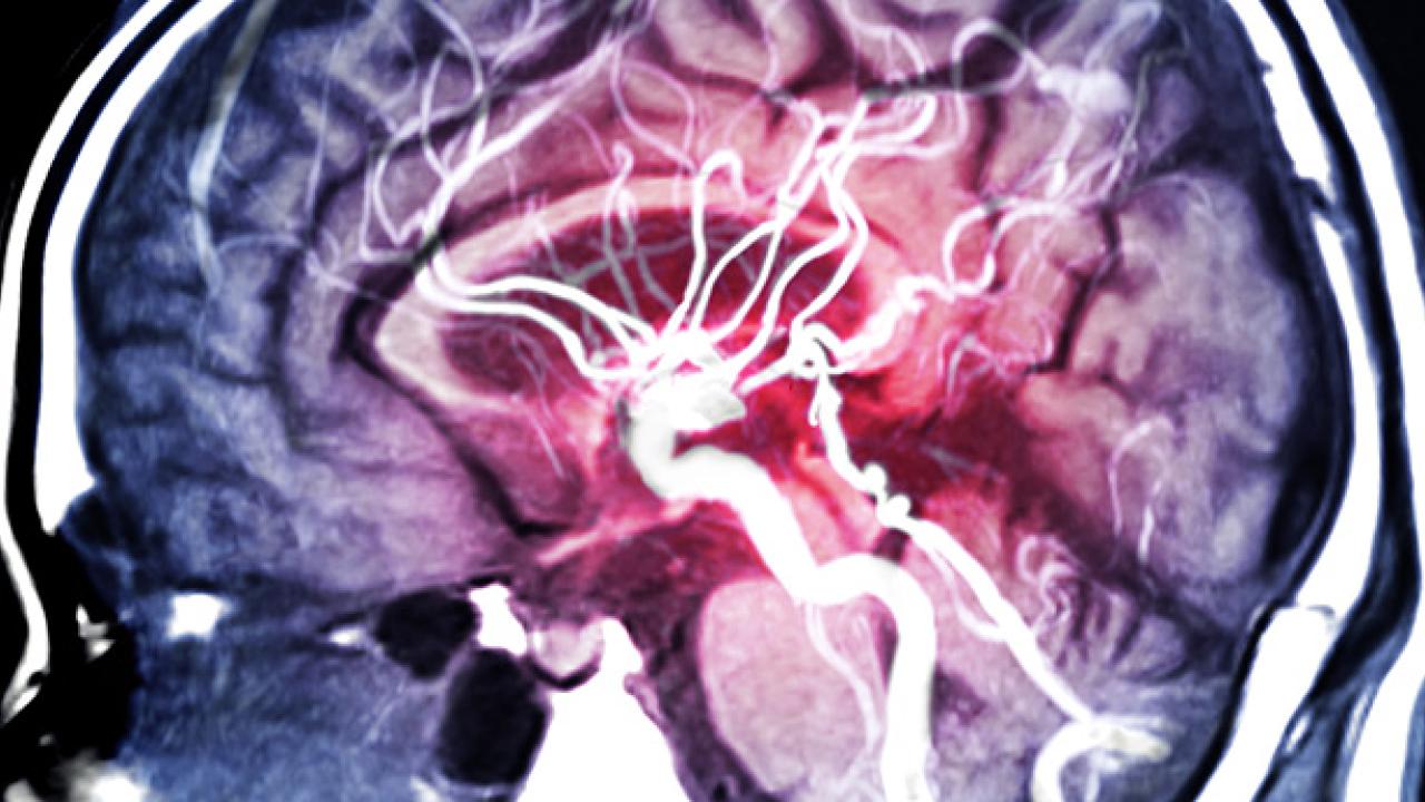 brain mri